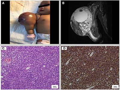 Early Surgery Is Feasible for a Very Large Congenital Infantile Fibrosarcoma Associated With Life Threatening Coagulopathy: A Case Report and Literature Review